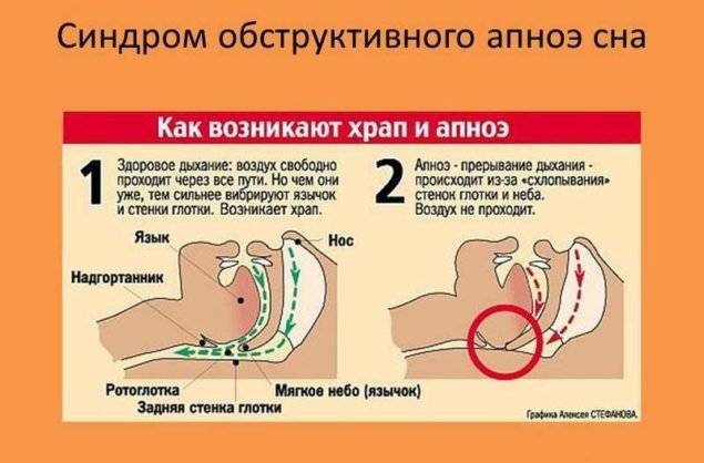 Синдром пиквика: симптомы, диагностика, лечение :: syl.ru