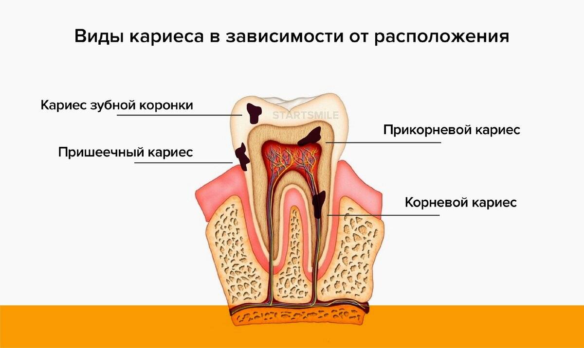 Лечение зубного кариеса: этапы, методы, средства, стадии