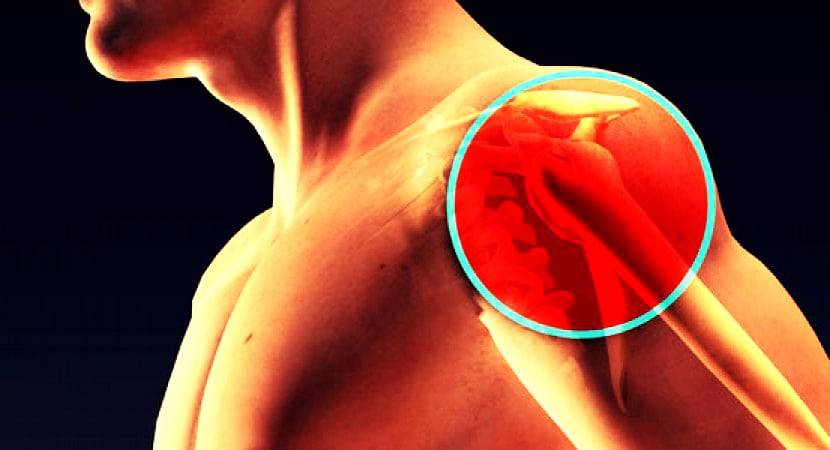 Чем лечить артрит плечевого сустава: симптомы и лечение в домашних условиях