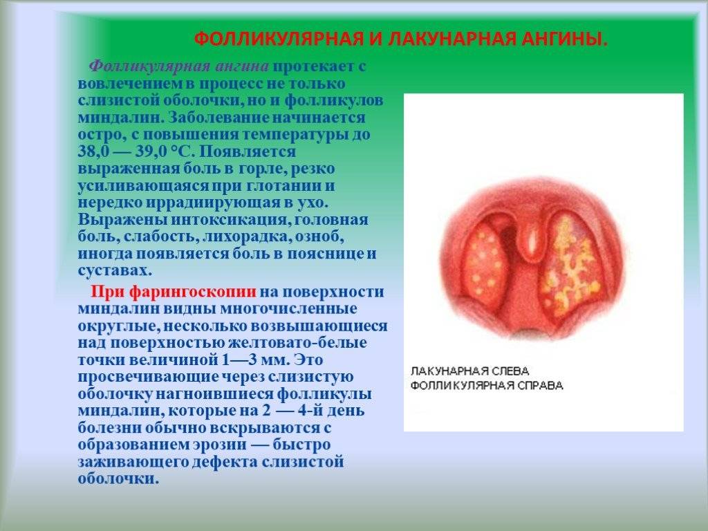 Некротическая ангина (симановского-венсана): симптомы и лечение