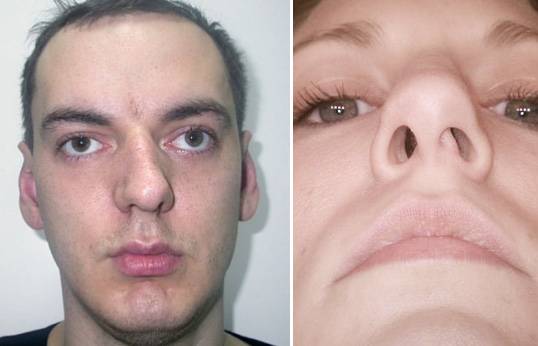 Причины и последствия искривленной перегородки носа - вашврач