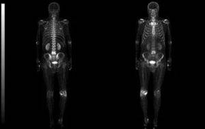 Что такое сцинтиграфия костей скелета