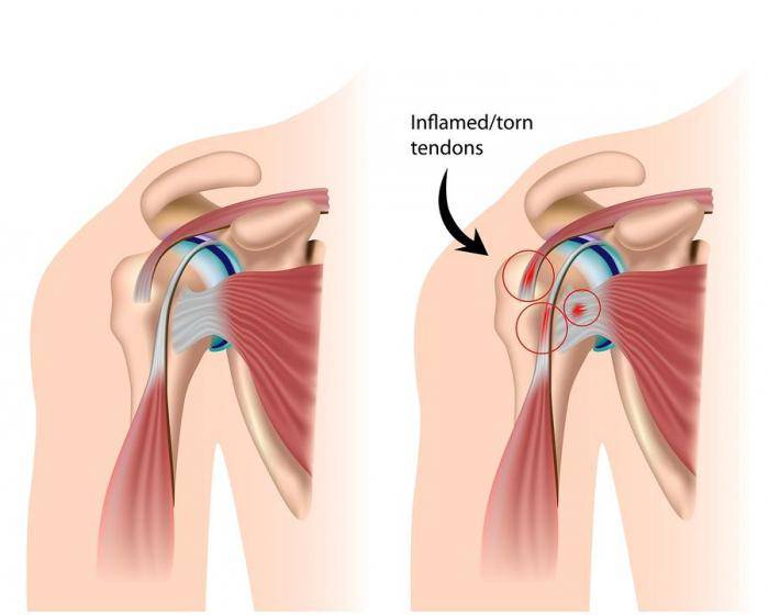Лечение импинджмент-синдрома плечевого сустава