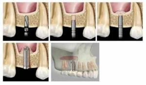 Что это такое синус лифтинг при имплантации зубов