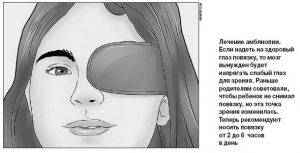 Лечение дальнозоркости | мнтк «микрохирургия глаза» им. акад. с.н. федорова