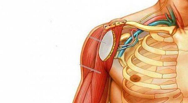 Нейропатия и плексопатия плечевого сплетения лечение - доктор горбунов