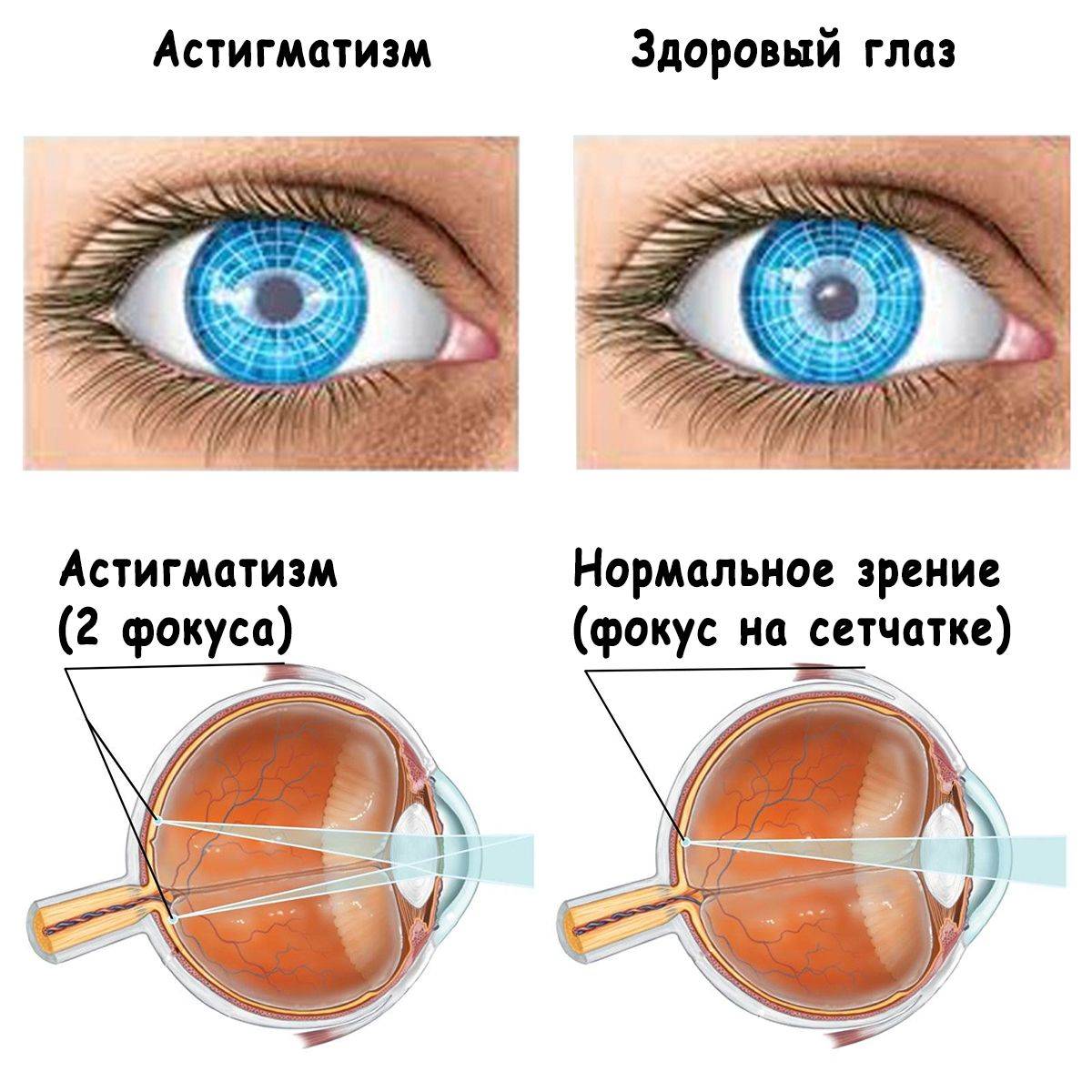 Астигматизм у ребенка (36 фото): что это такое, лечение глаз при сложной гиперметропической форме, как обследовать, причины