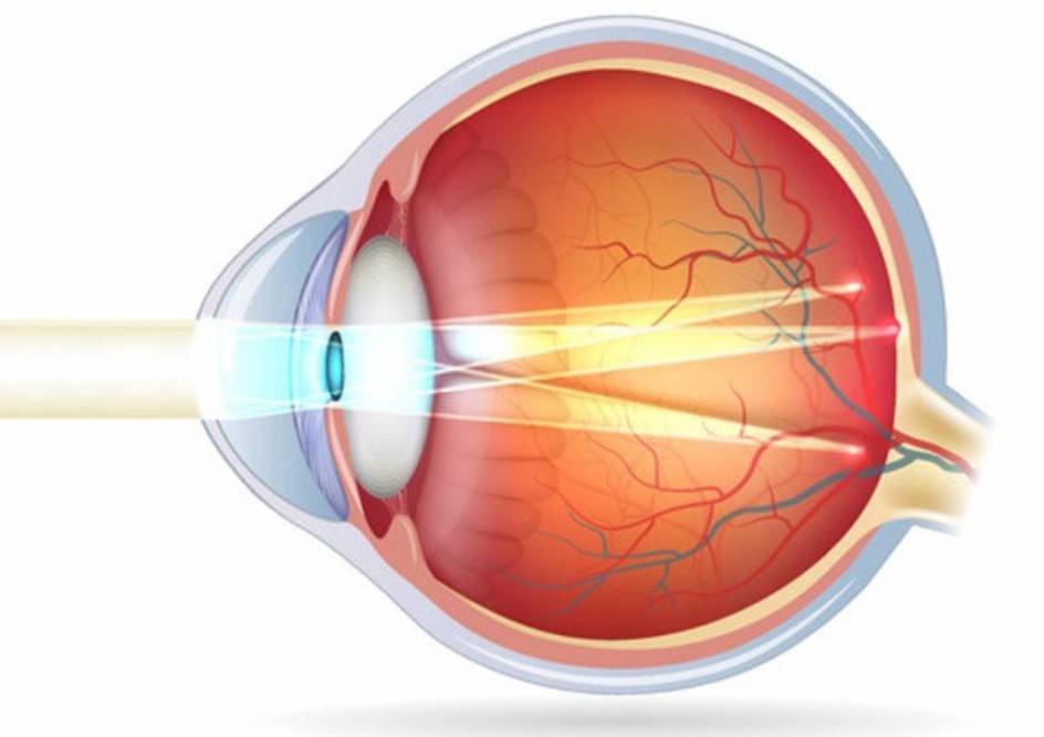 Лазерная коррекция зрения при астигматизме — лечение и цены