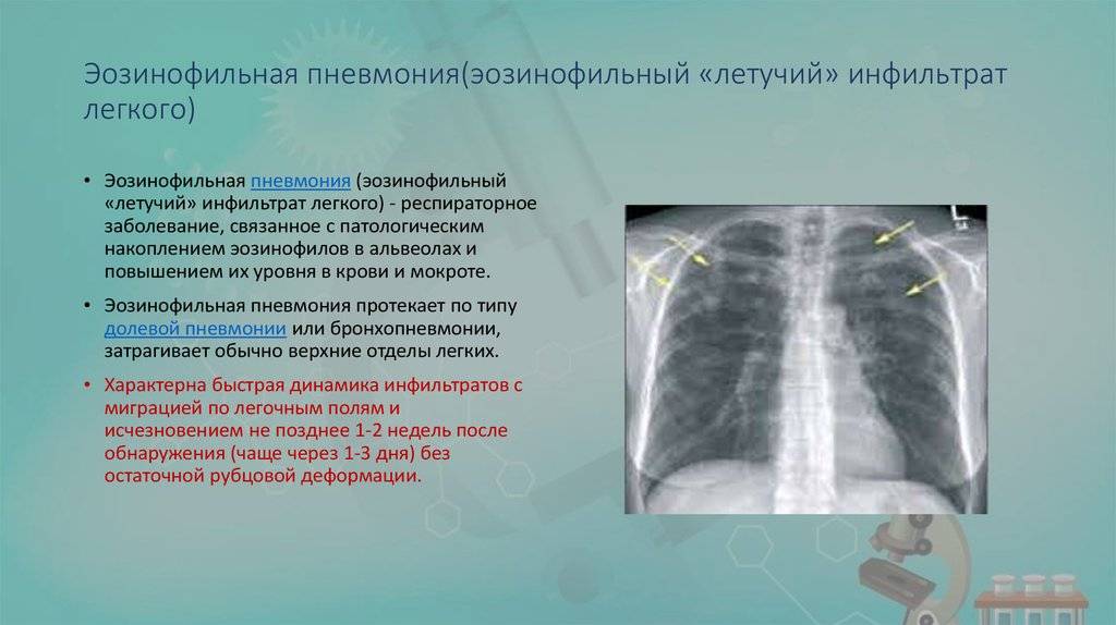 Эозинофильная пневмония: чем отличается? как лечить? | pnevmonya.ru