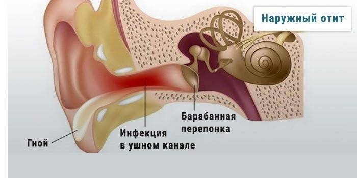 Основные симптомы и лечение отита среднего уха