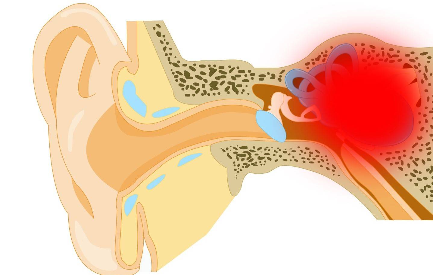 Как вылечить отит уха в домашних условиях: симптомы и лечение наружного, среднего, экссудативного, хронического, гнойного, острого, капли, катарального