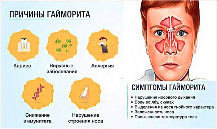 Синусит симптомы и лечение у детей