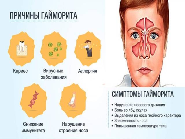 Гайморит: симптомы и лечение у взрослых, отзывы и признаки заболевания у ребенка