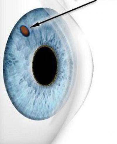 Лазерная иридэктомия: преимущества и недостатки - здоровое око