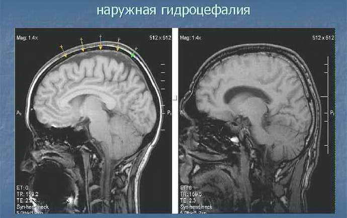 Смешанная заместительная гидроцефалия головного мозга