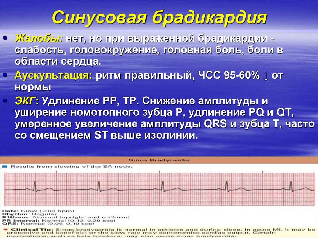 Брадикардия сердца у взрослых: что это такое, код по мкб-10 и частота пульса, причины возникновения, симптомы и лечение синдрома, профилактика и последствия