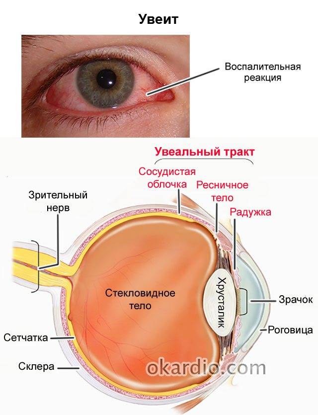 Что такое увеит глаза и как его лечить?