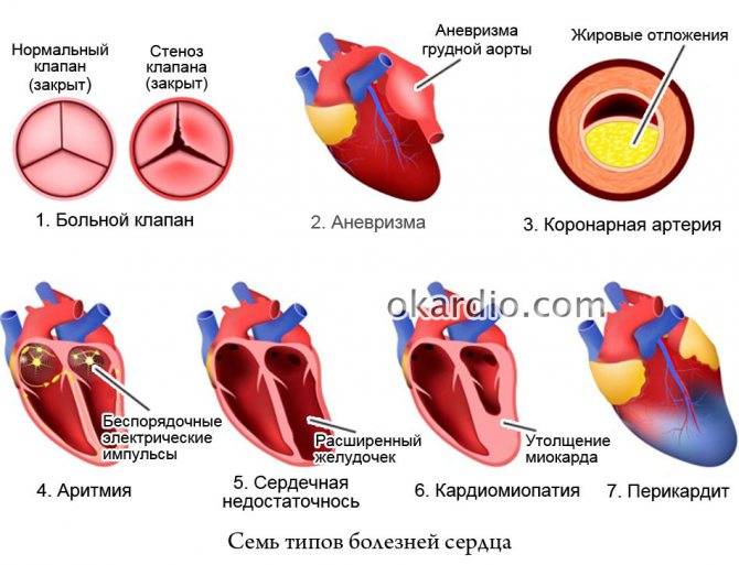 Признаки стенокардии и аритмии сердца
