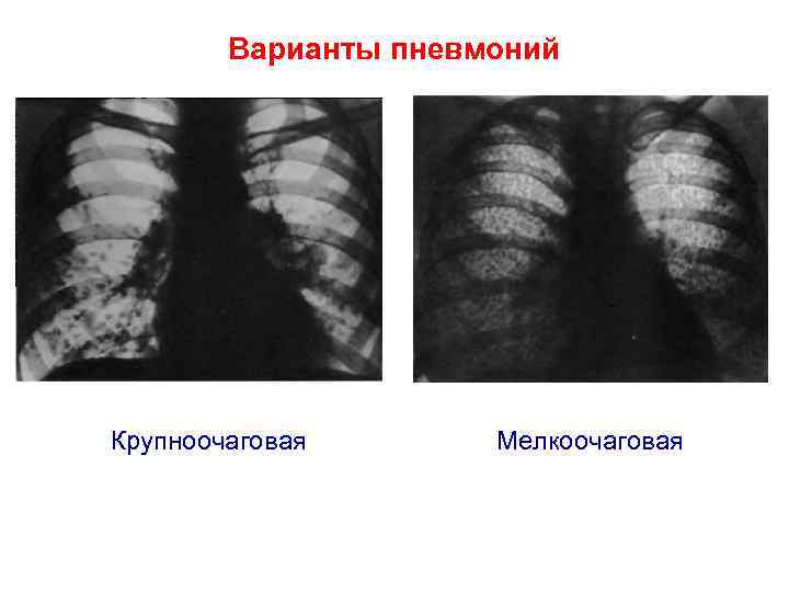 Очаговая пневмония у детей: симптомы, лечение pulmono.ru
очаговая пневмония у детей: симптомы, лечение