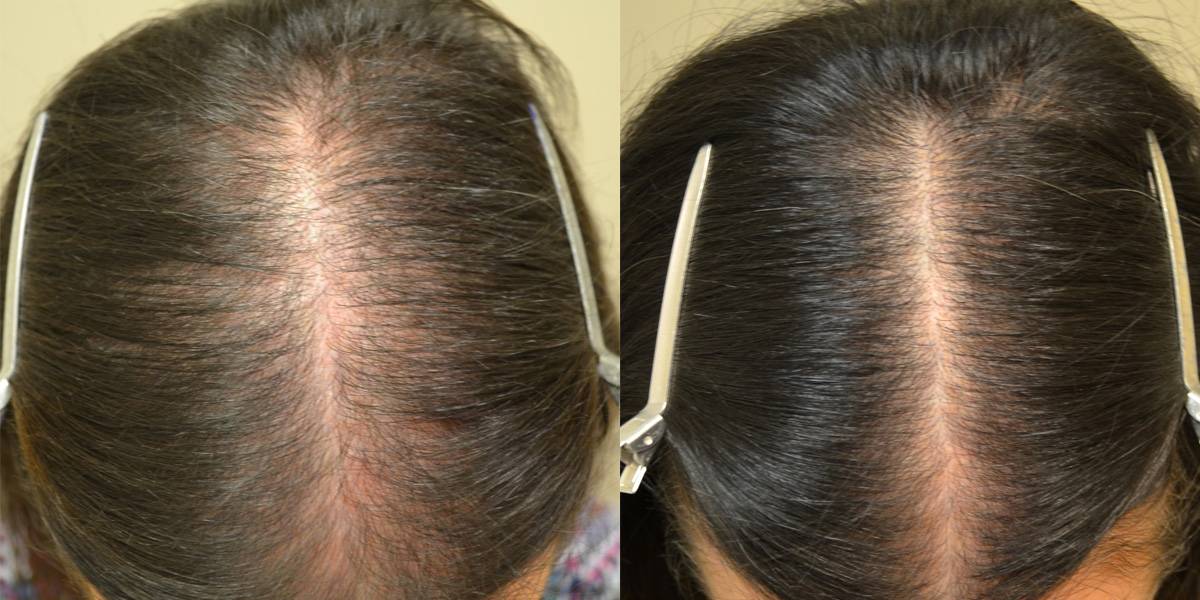 Алопеция — лечение, профилактика выпадения волос средствами alerana