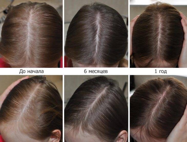 Андрогенная алопеция у мужчин и женщин: как сохранить волосы