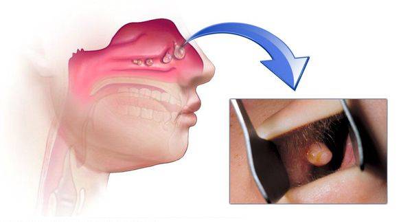 Полипы в носу: способы лечения без операции