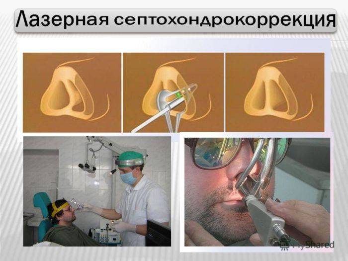 Операция при искривлении носовой перегородки (септопластика)