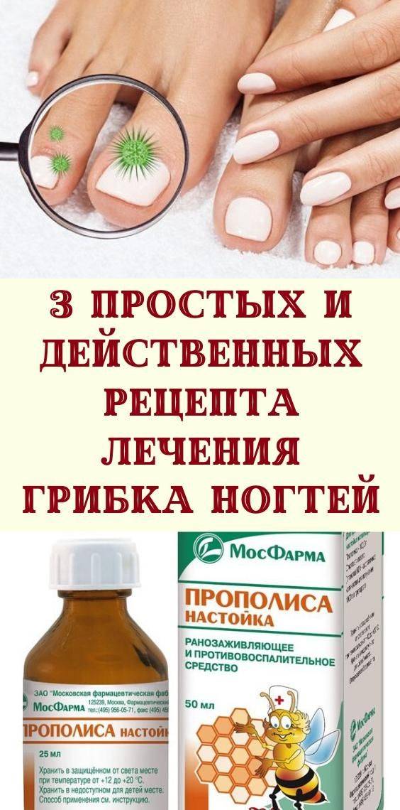 Лечение грибка на ногах народными средствами - эффективные рецепты домашних ванночек и препаратов