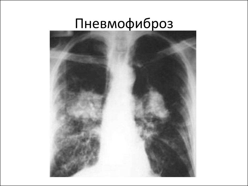 Фиброзные изменения в легких после пневмонии