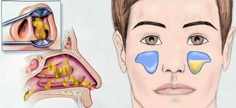 Носовые пазухи - воспаление, лечение если воспалились, чем лечить, как снять: препараты при гайморите лобных придаточных носа, симптомы