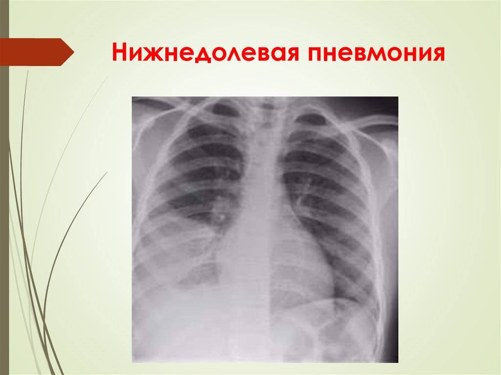 Очаговая пневмония у детей: симптомы, лечение pulmono.ru
очаговая пневмония у детей: симптомы, лечение