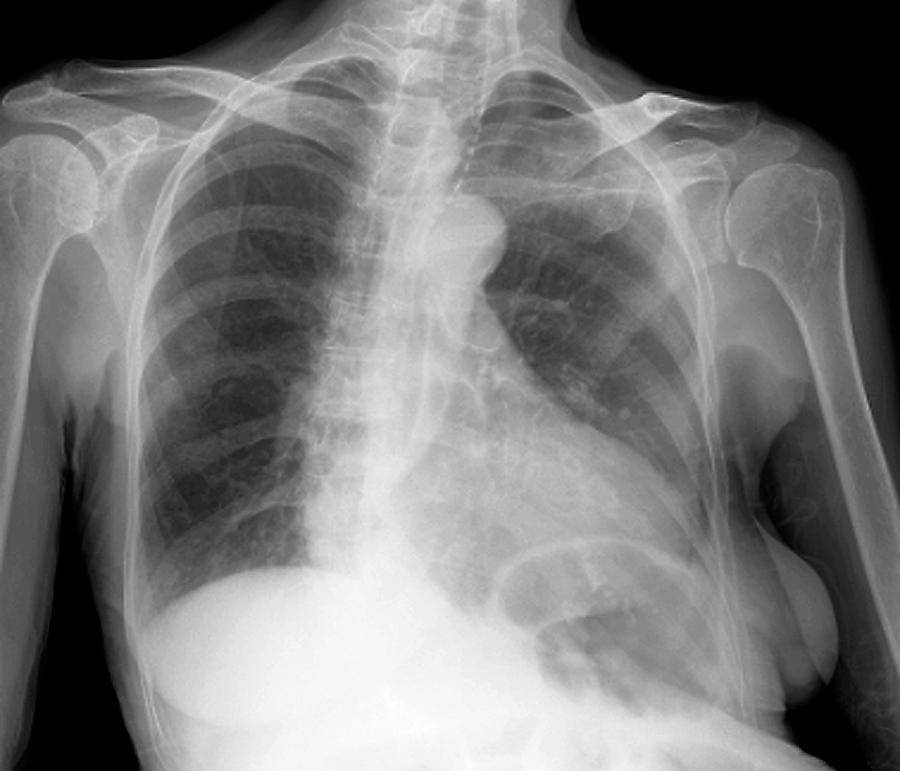 Что такое диагноз кардиомегалия у человека, причины и признаки
