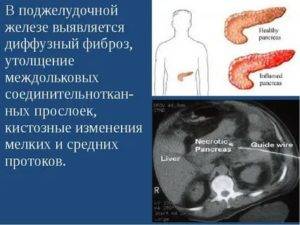 Поджелудочная железа диффузные изменения по типу липоматоза народными средствами