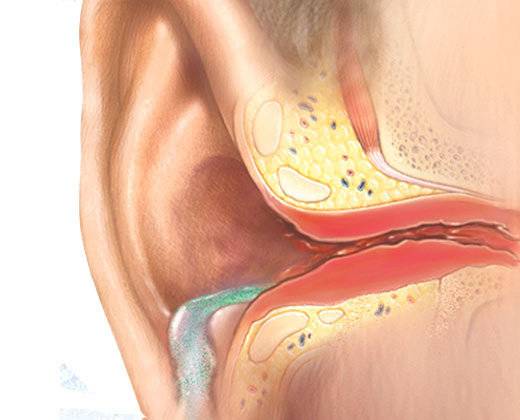 Отит наружного уха: симптомы, препараты и схема лечения