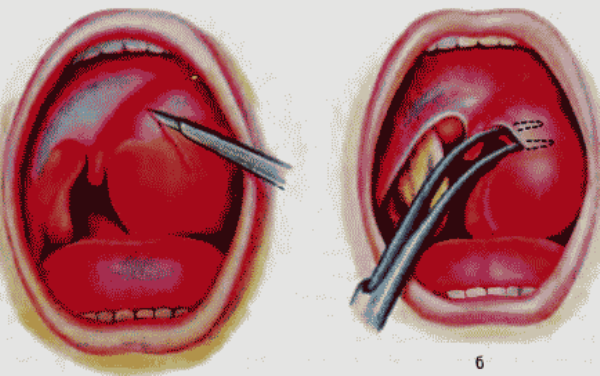 Фолликулярная ангина – степень опасности болезни