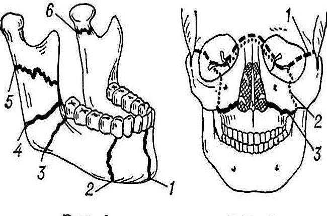 Особенности перелома верхней челюсти: классификация по лефору, диагностика, лечение