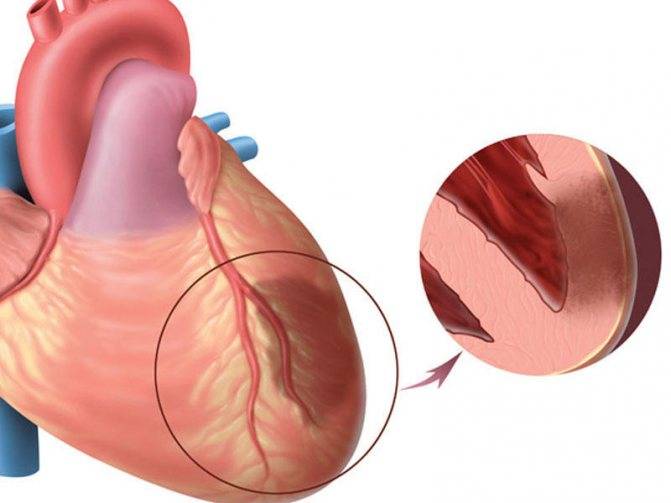Разрыв миокарда как осложнение инфаркта: причины, показания на экг, как восстановить стенки сердца