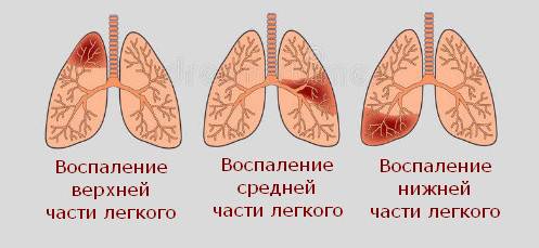 Правосторонняя верхнедолевая пневмония лечение — proinfekcii.ru