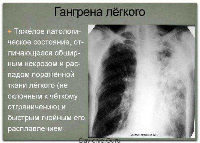 Крупозная (воспалительно-аллергическая) пневмония