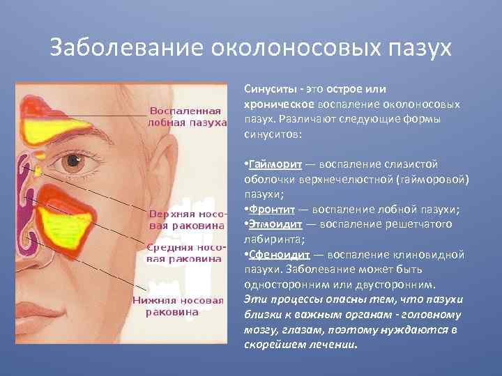Воспаление носовых пазух: симптомы и лечение в домашних условиях