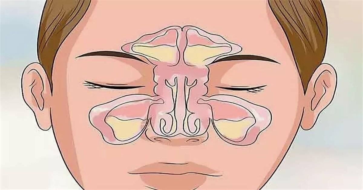 Закладывает нос без насморка – причины и лечение заложенности