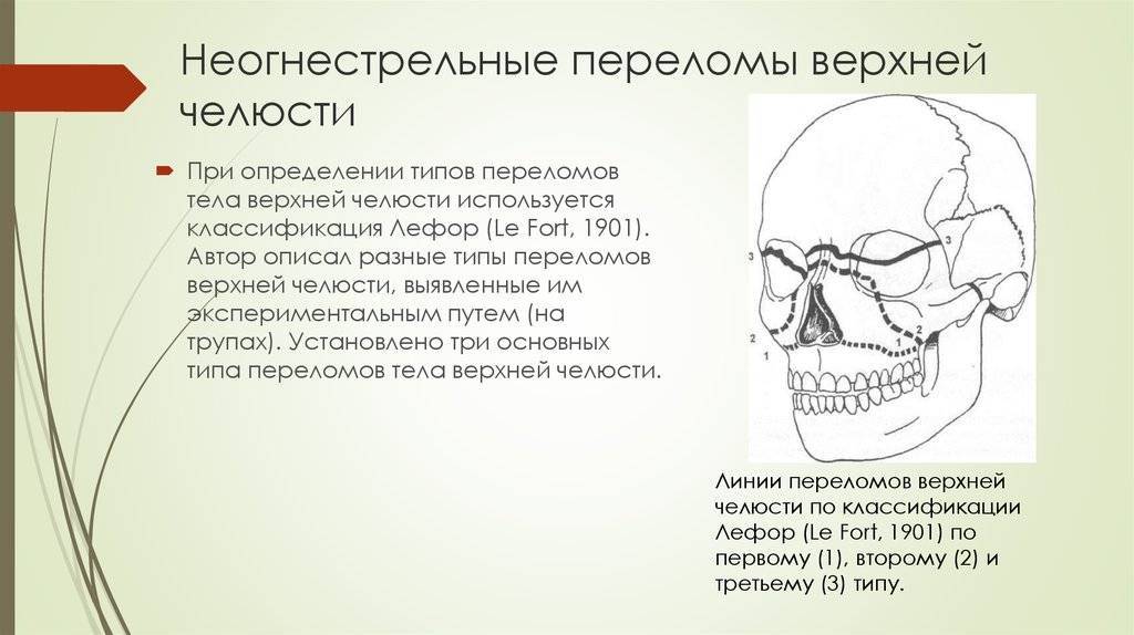 Перелом челюсти