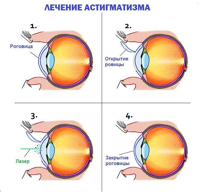 Астигматизм миопический - это близорукость, чем простая отличается от сложной, прямая миопия обоих глаз, амблиопия
