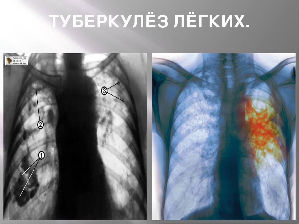 Можно ли полностью и навсегда вылечить туберкулез легких?