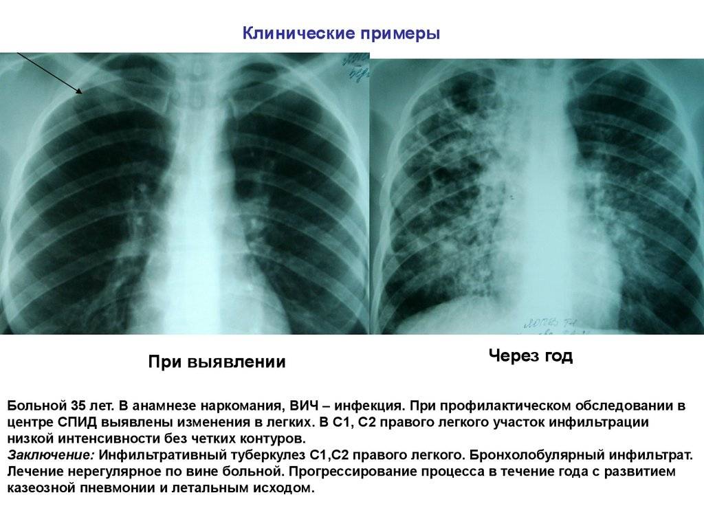Очаговый туберкулез легких: заразен или нет, лечение, симптомы, сколько лечиться и как передается?
