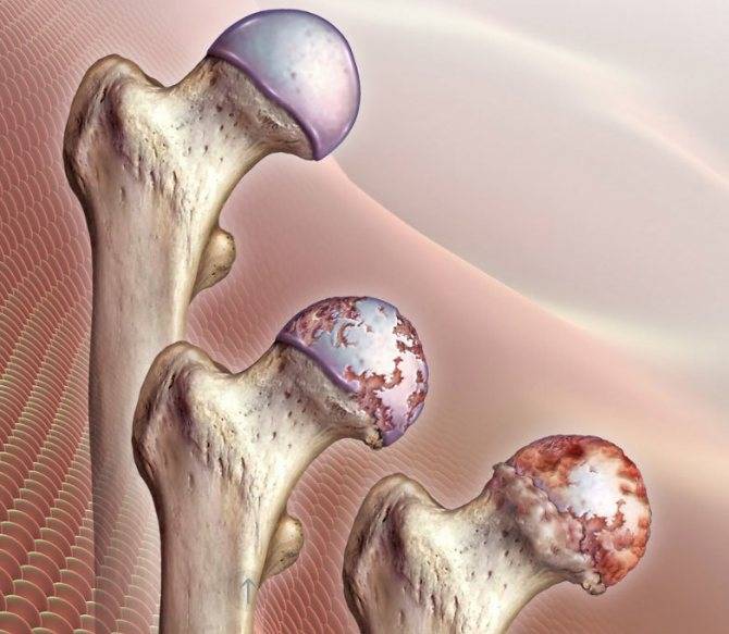 Лечение артроза тазобедренного сустава народными средствами | лечение суставов