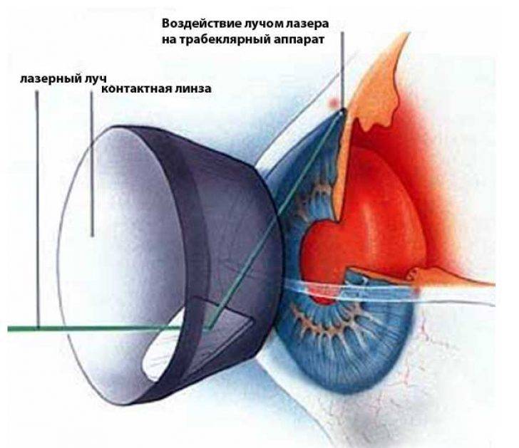 Лазерная иридэктомия: преимущества и недостатки - здоровое око | za-rozhdenie.ru