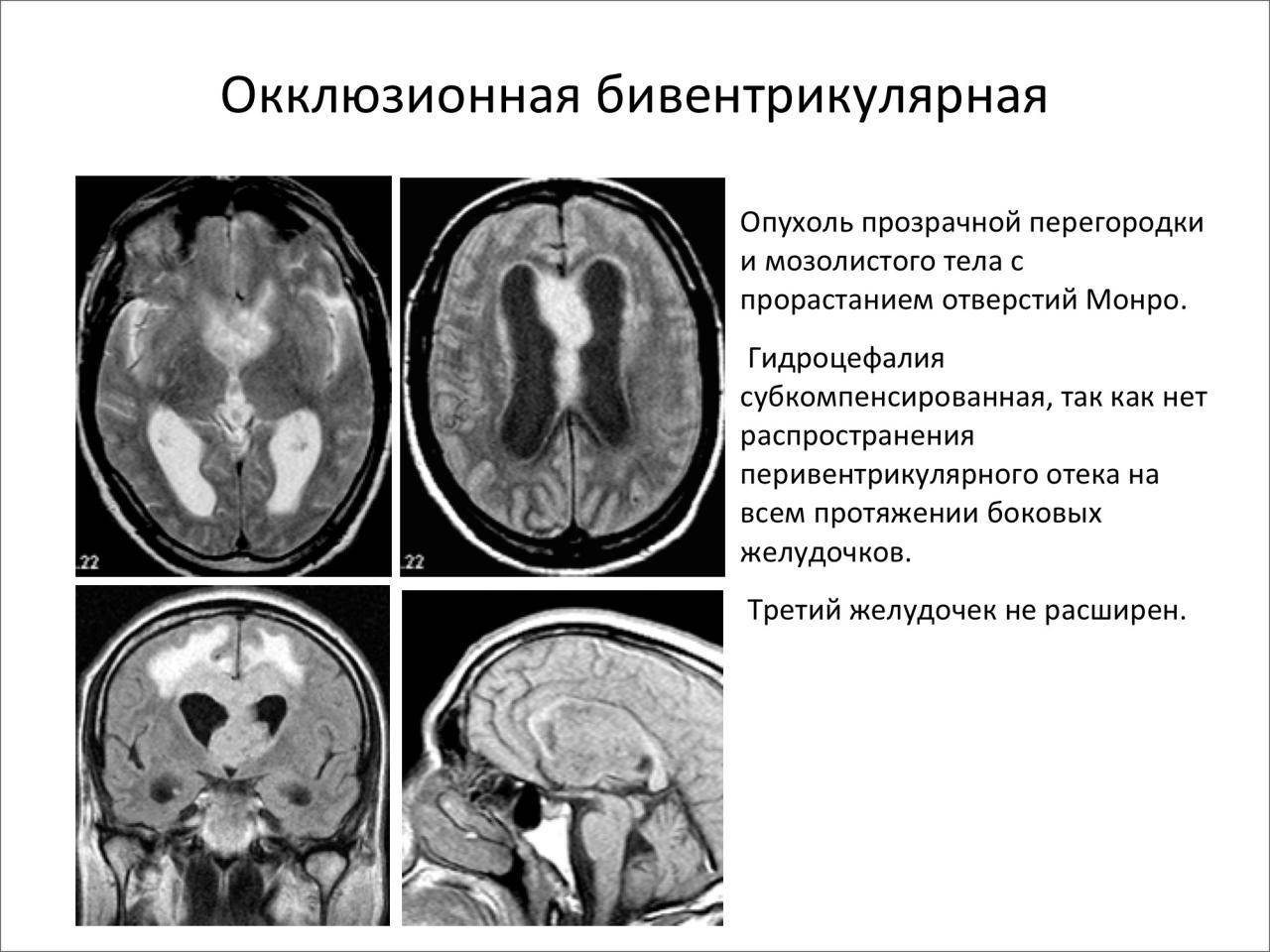 Гидроцефалия головного мозга у взрослого: лечение наружной и умеренной формы