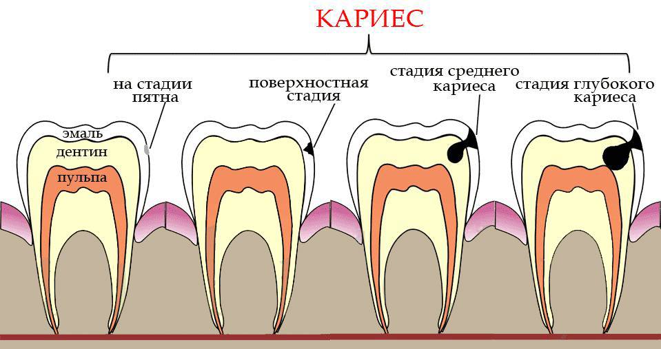 Современные методы лечения кариеса — неинвазивные способы для восстановления зубов
