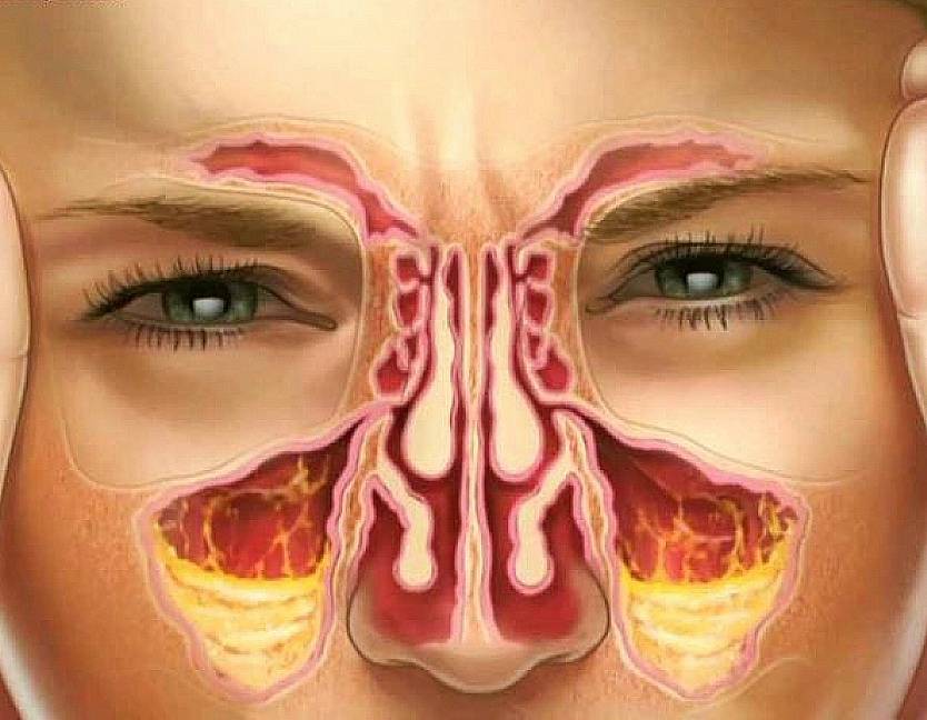 Воспаление носовых пазух: симптомы и лечение, как и чем лечить